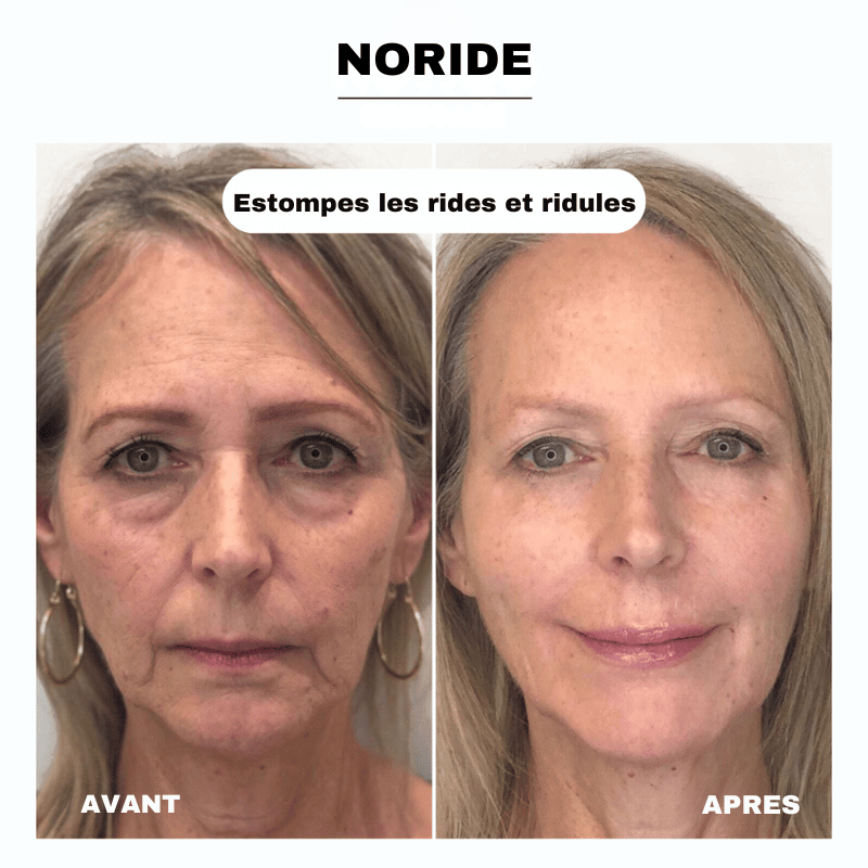 Cure de Collagène Sans Aiguilles