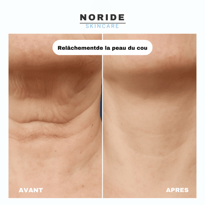 Cure de Collagène Sans Aiguilles