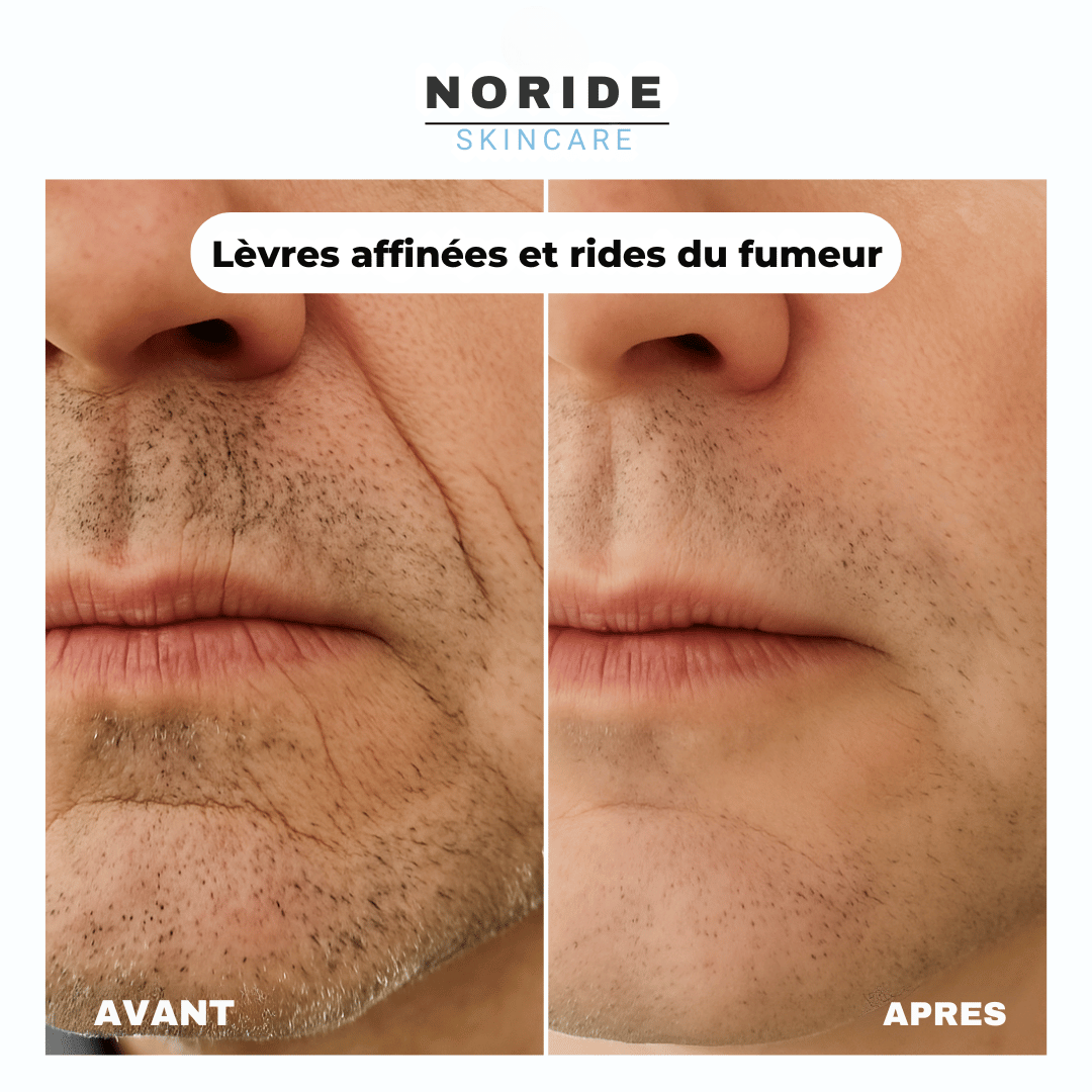 Cure de Collagène Sans Aiguilles